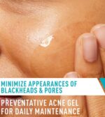 Acne Control Gel - Image 2