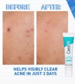 Acne Control Gel - Image 3